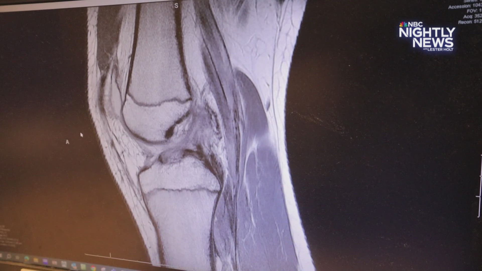 9Health Expert Dr. Payal Kohli discusses a new study on treatment for ACL tears.